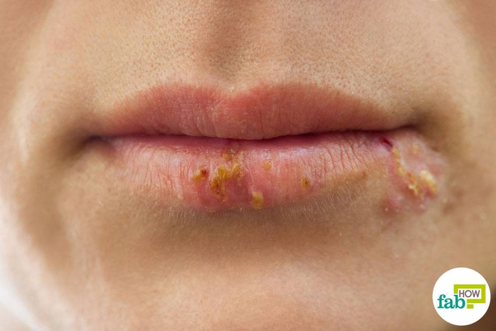 Meat recomended herpes facial Herpes Early simplex signs of