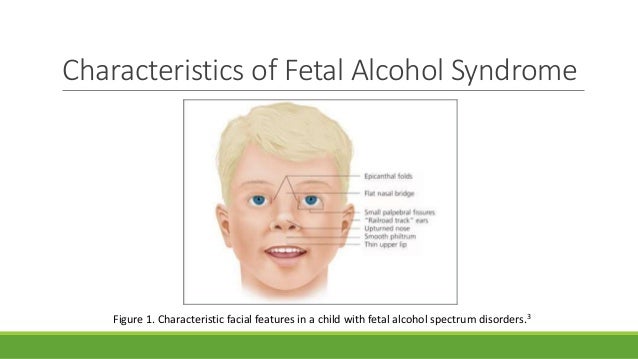 best of Alcohol features facial spectrum Fetal disorder