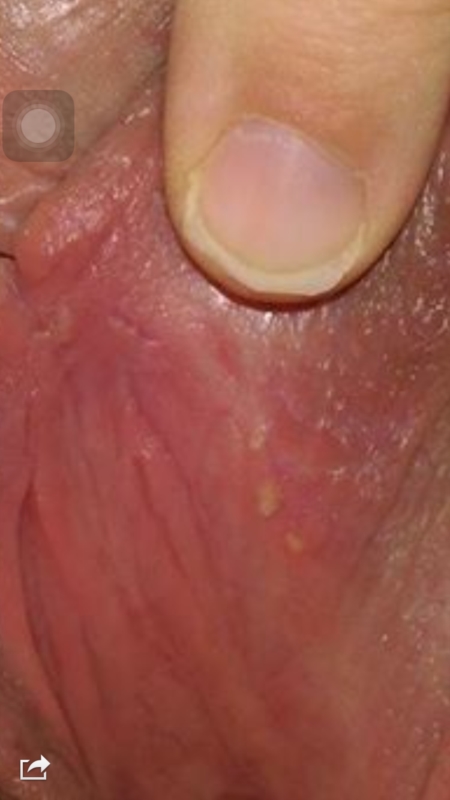 best of Blisters lesion Painful vaginal with