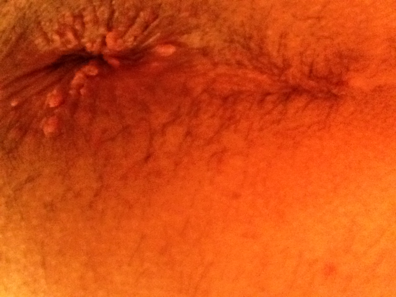 Painful lump near anus image