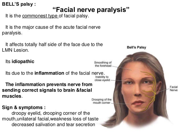 best of Unilateral facial paralysis Pediatric