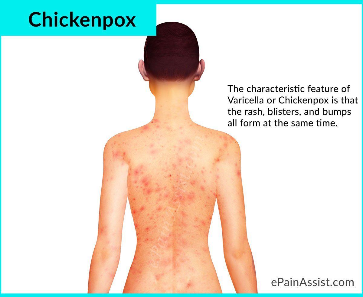 Pharoah reccomend Adult chicken pox look like