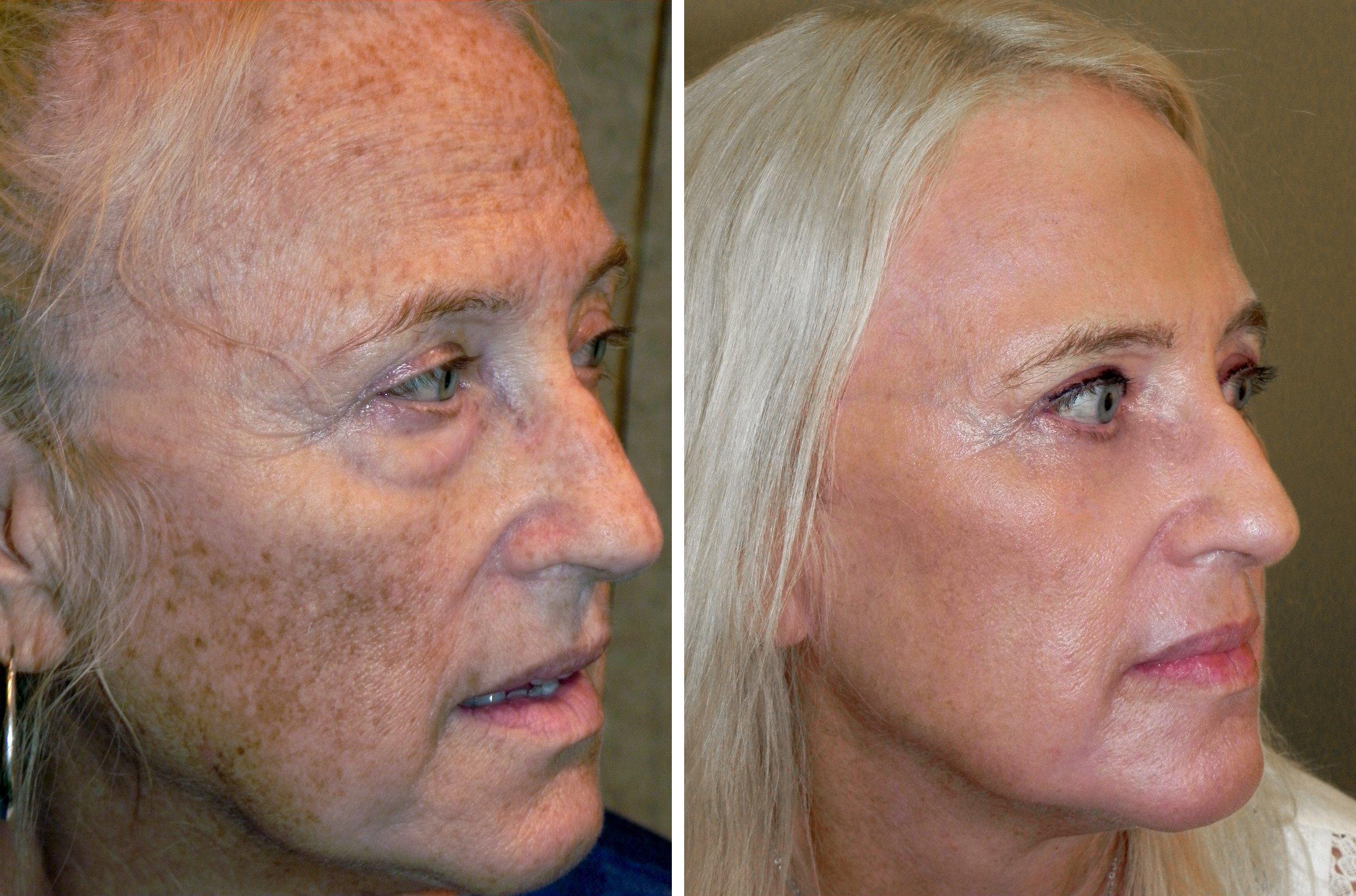 Laser reccomend Facial rejuvination cost