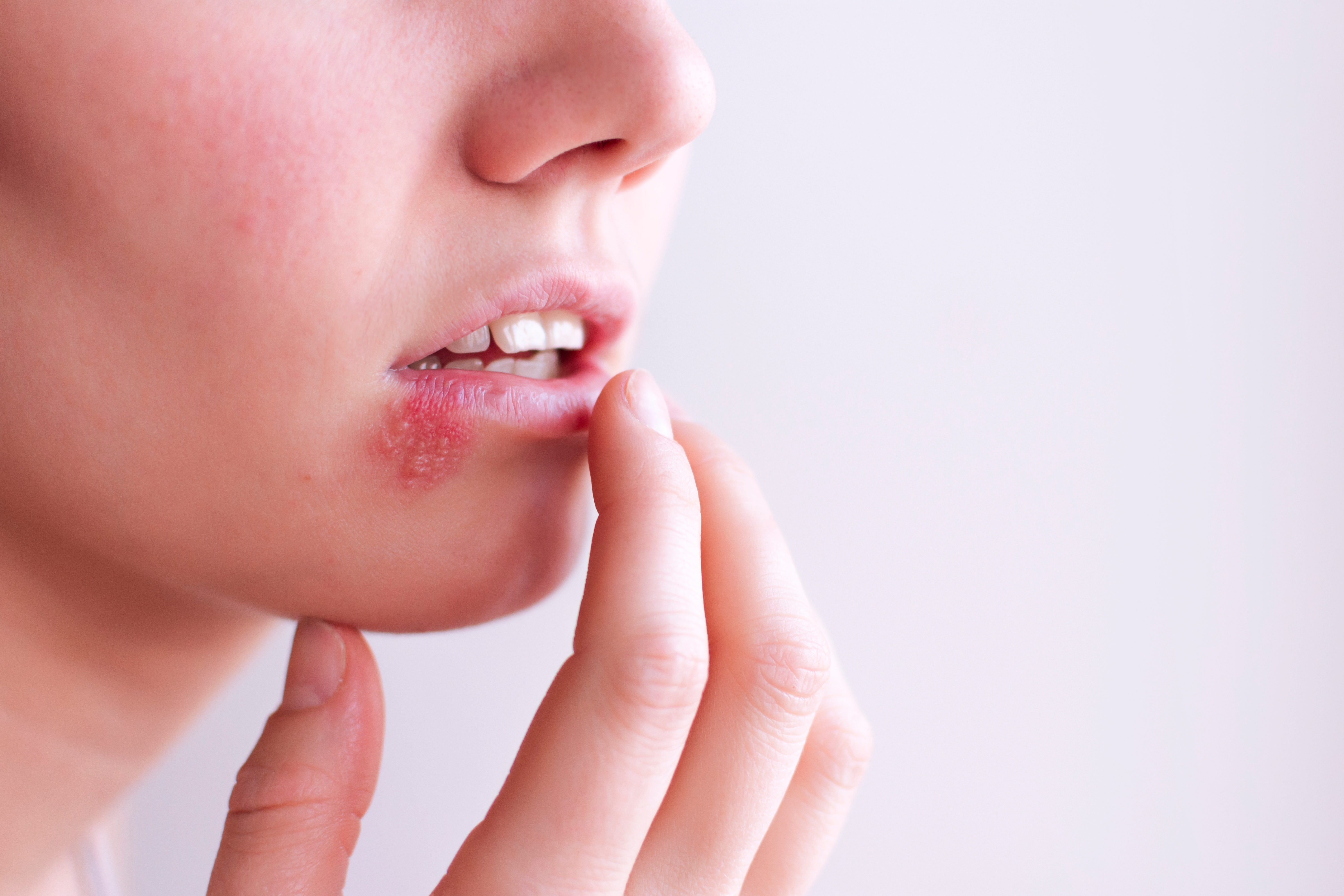 Early signs of facial herpes Herpes simplex