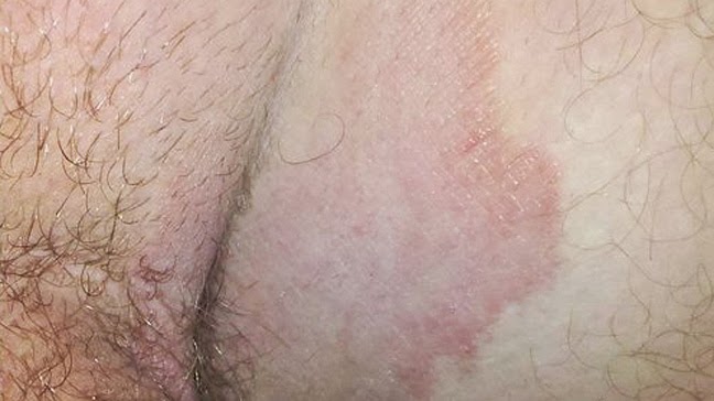 Anal itching with dead skin