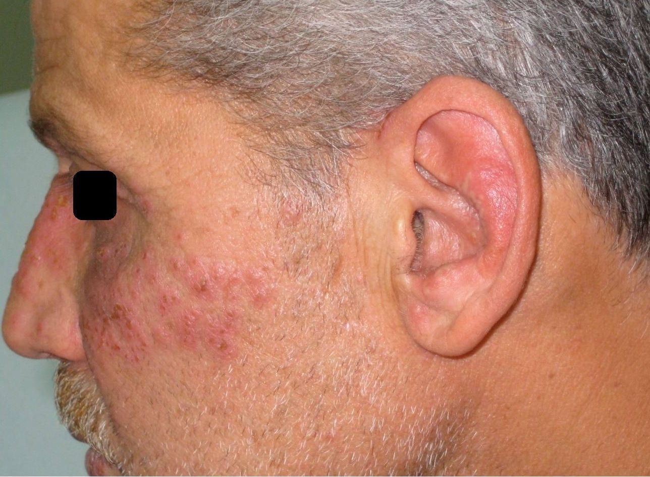 best of Of Early Herpes herpes simplex facial signs