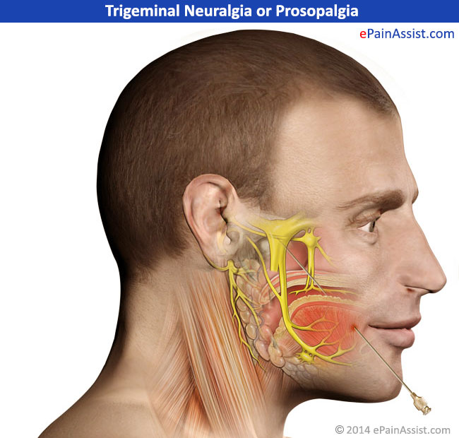 Facial paralysis and neuralgia