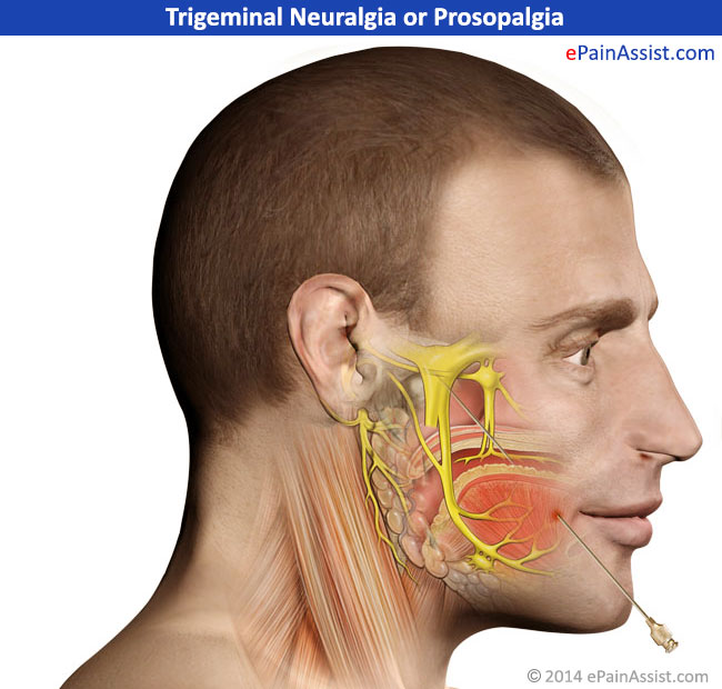 Sabertooth reccomend Facial paralysis and neuralgia