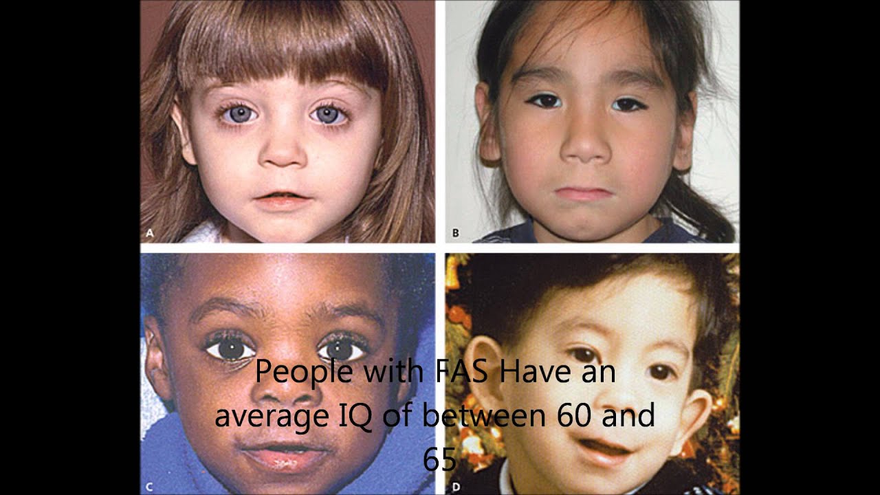 Fetal alcohol spectrum disorder facial features