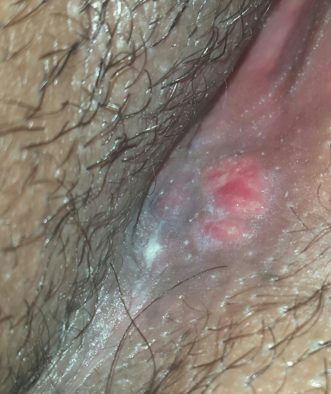 best of Blisters lesion Painful vaginal with