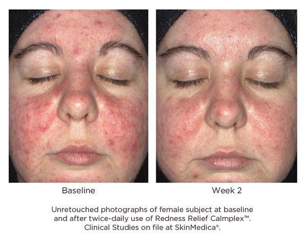 Venus reccomend Facial redness cream pro