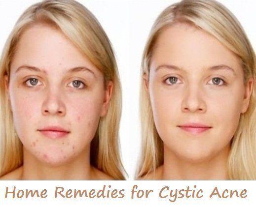 best of Facial cysts Juice