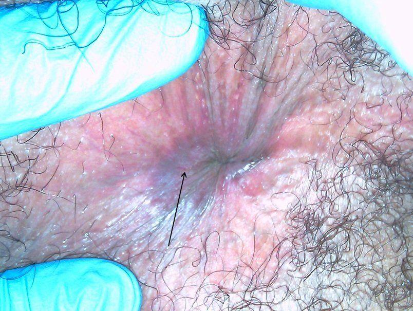 best of Disease fissures Crohns and anal