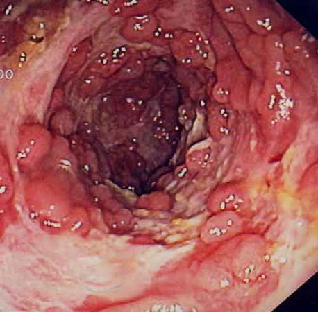 Crohns disease and anal fissures