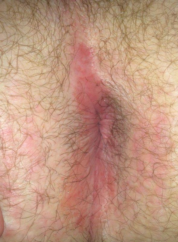 best of Anus from antibiotics Itchy bloody