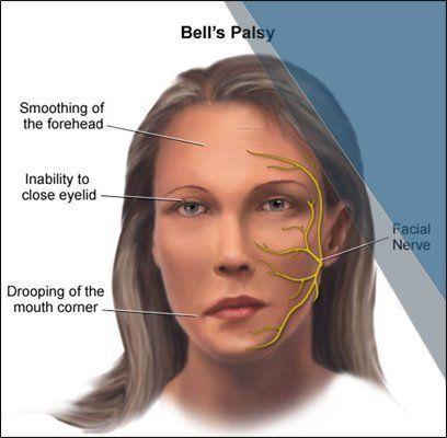 best of Palsy aging Facial or