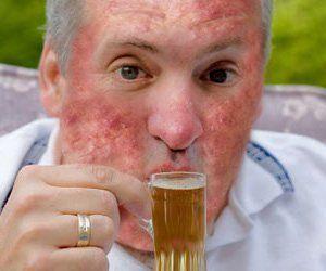 Can beer or wine cause facial rash
