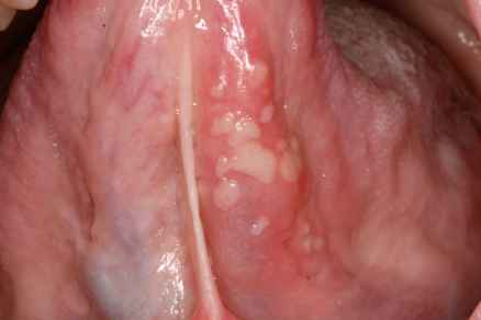 Mizzen reccomend White bumps on clitoris