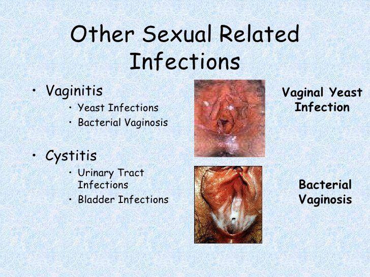 best of Symptoms vagina Bacteria the in