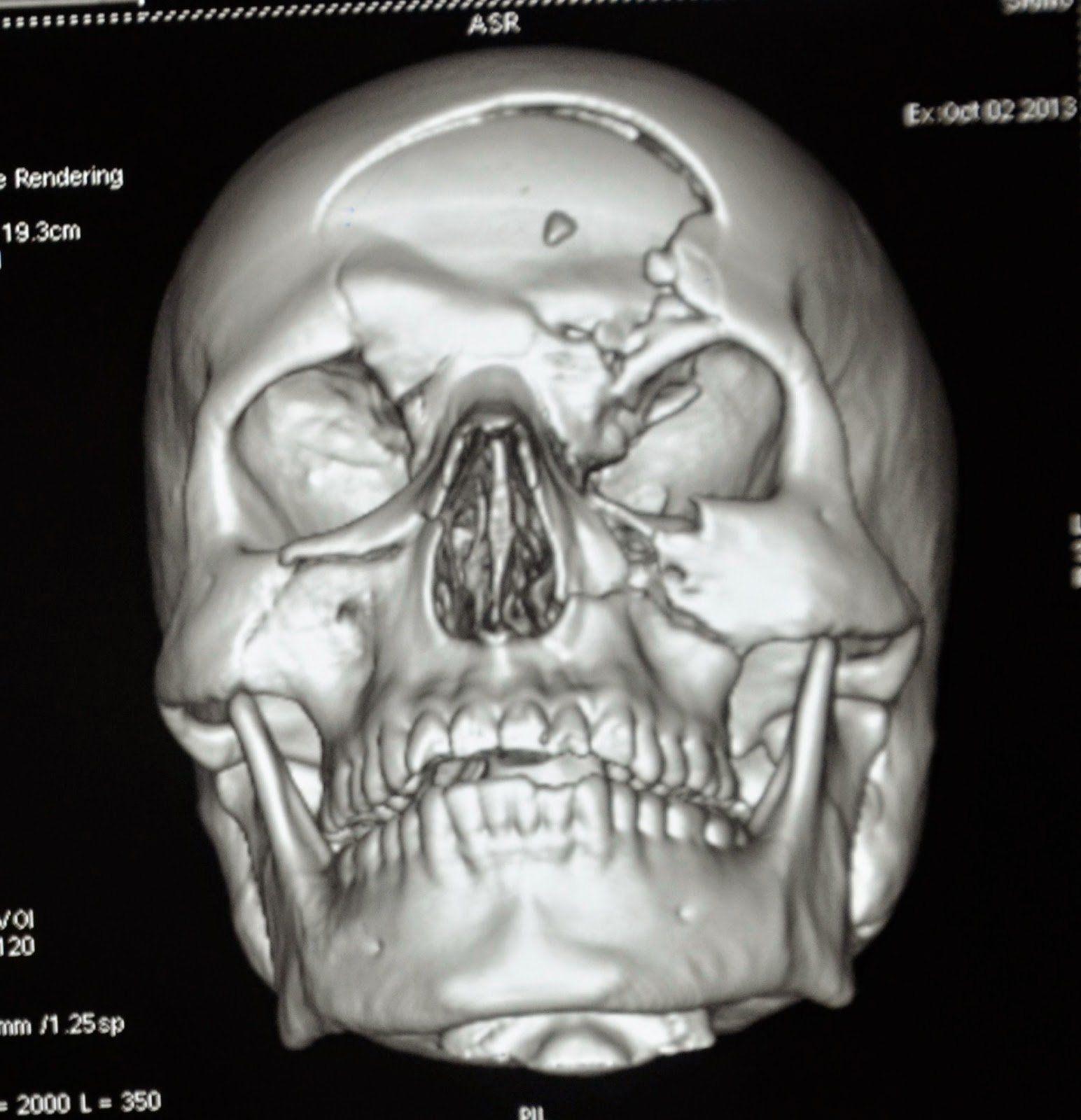 best of Facial fracture Bone