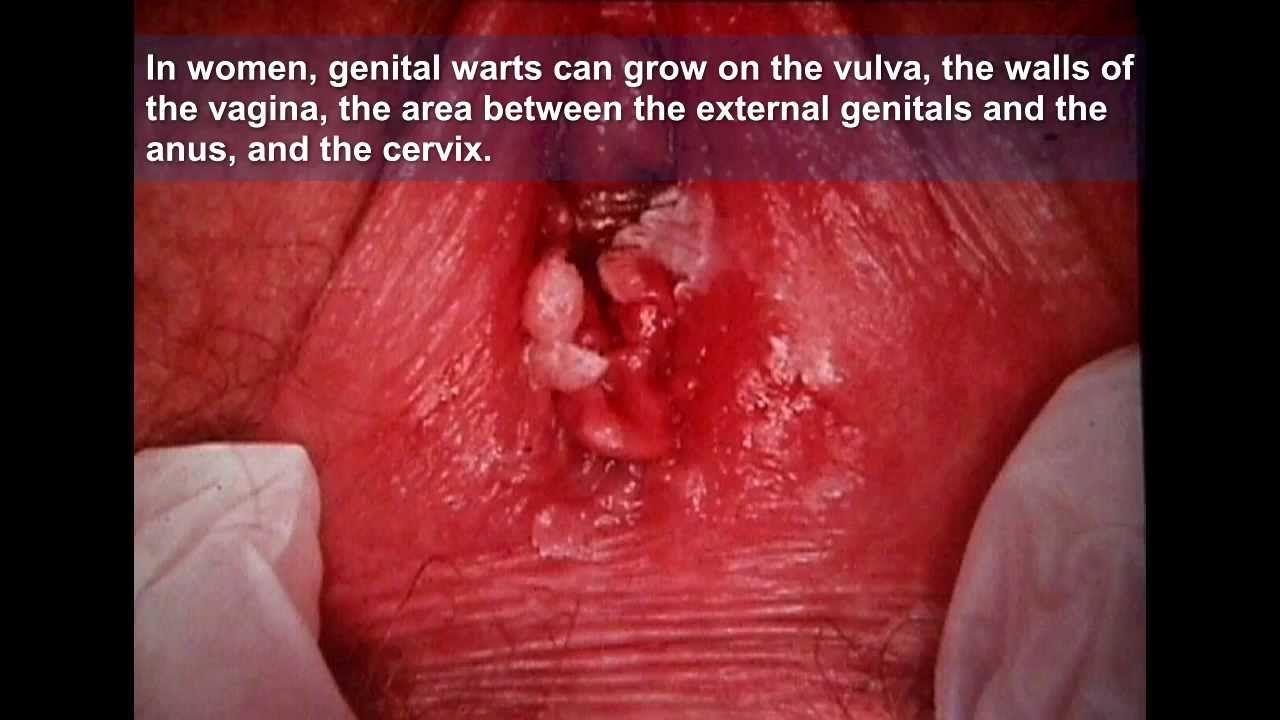 best of The vagina Genital wart inside
