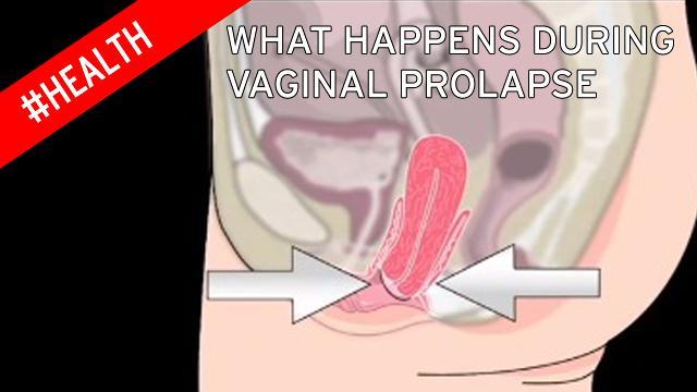D-Day reccomend Bladder hanging out of vagina