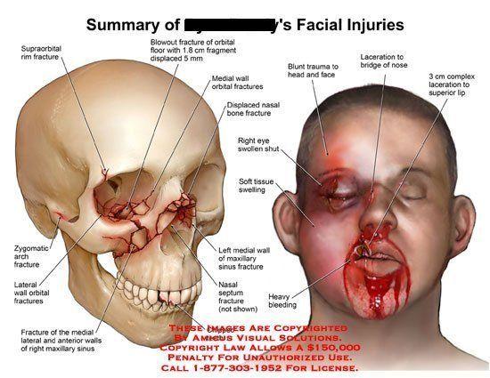 Spice reccomend Bone facial fracture