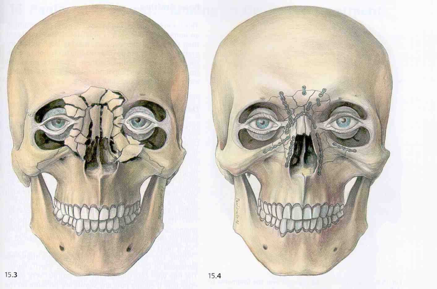 Bone facial fracture