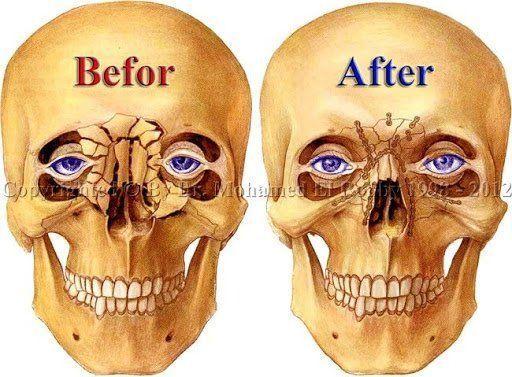 best of Facial fracture Bone