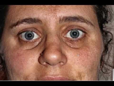 Cell deficiency diagnosis facial salt