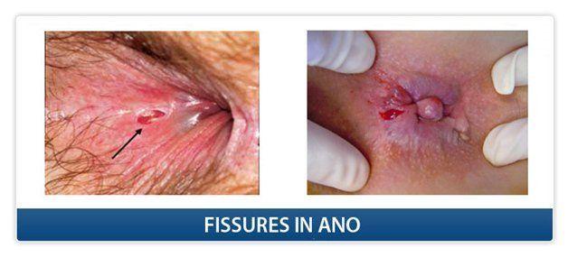 Crohns disease and anal fissures