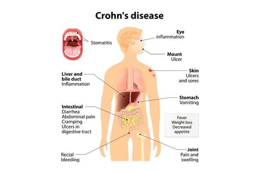 Dakota reccomend Crohns disease and anal fissures