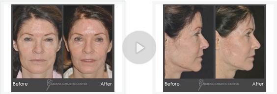 best of Palm florida county peels beach Facial