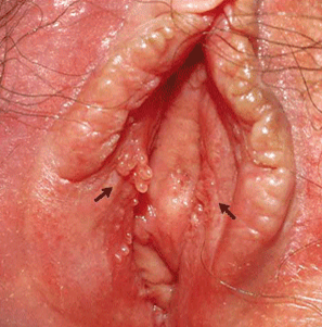 best of The vagina Genital wart inside