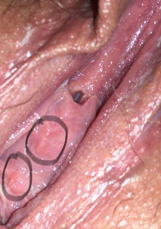Peanut reccomend Genital wart inside the vagina