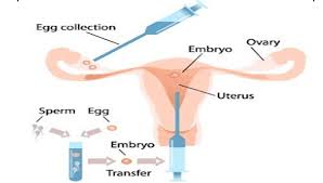 best of Sperm Infertility donor