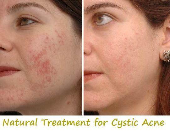 Offense reccomend Juice facial cysts