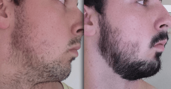 Minoxidil facial hair growth