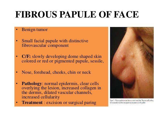 Wild R. reccomend Treatment for fibrous papules facial angiofibroma