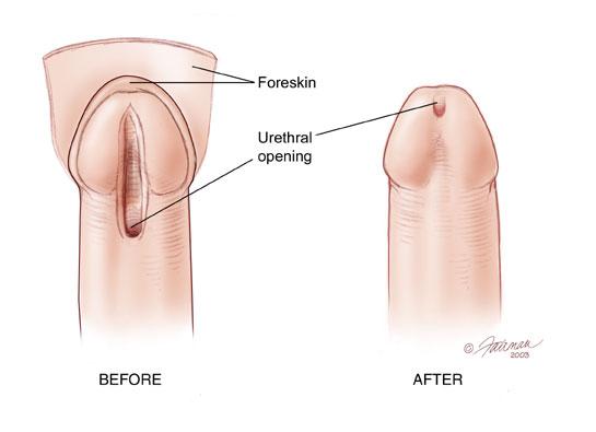 Urethral syndrome and masturbation