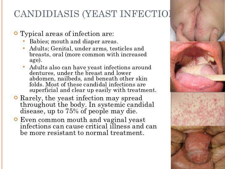 best of Oral caused sex infection by Yeast